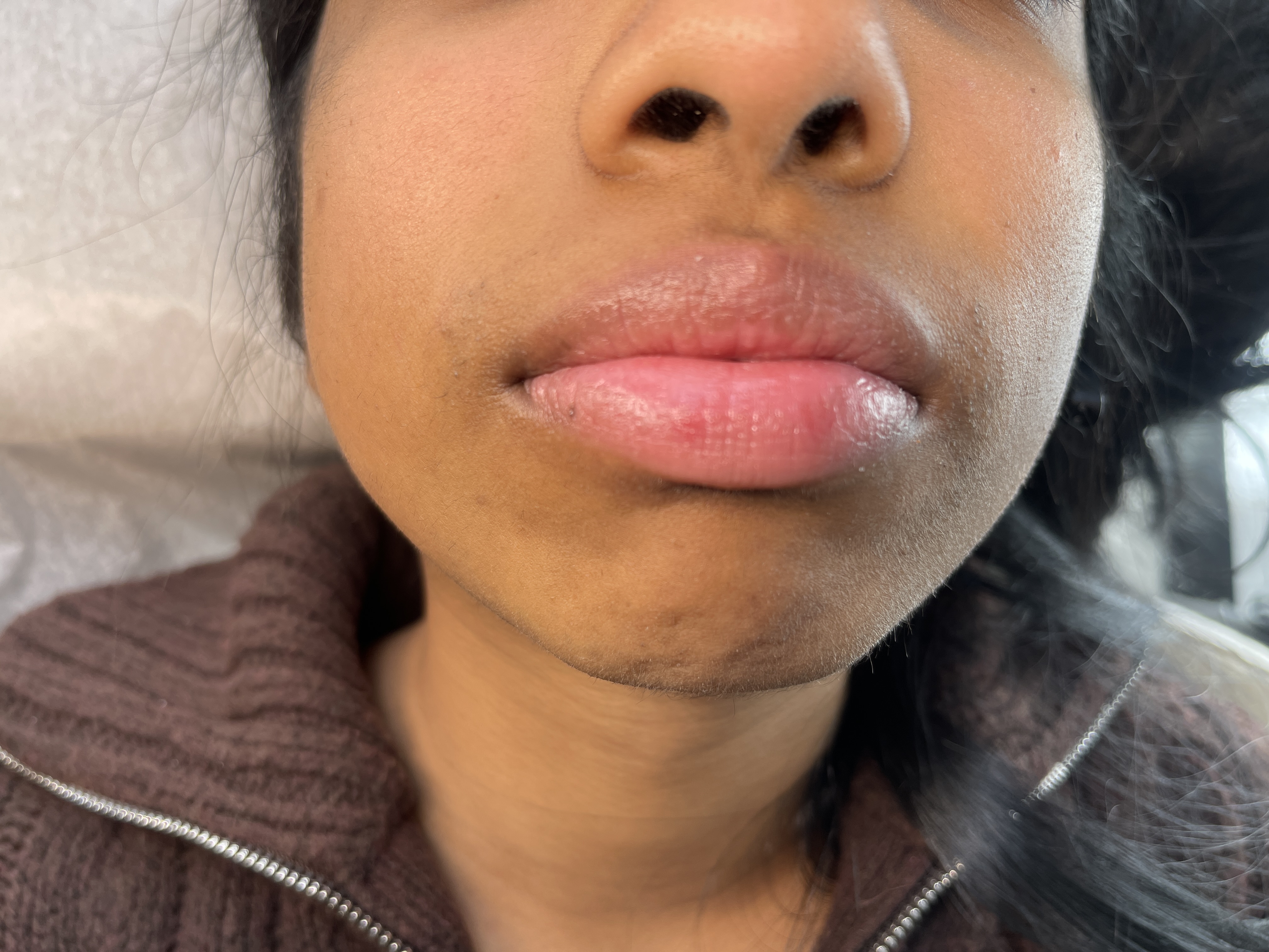 After electrolysis treatment