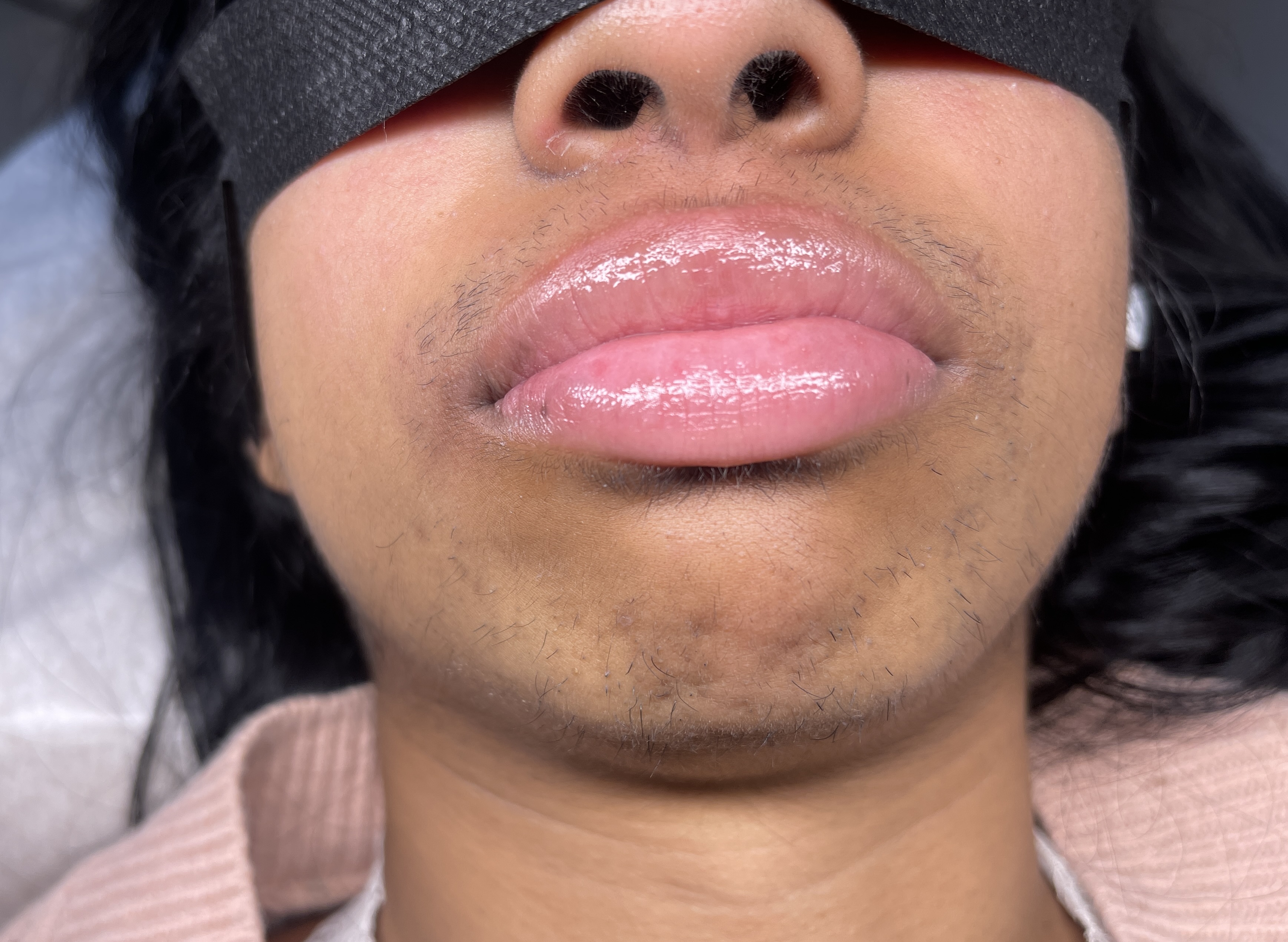 Before electrolysis treatment